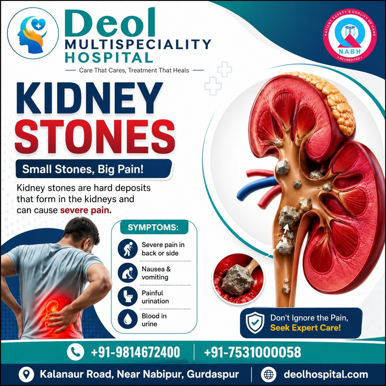 Kidney Stones